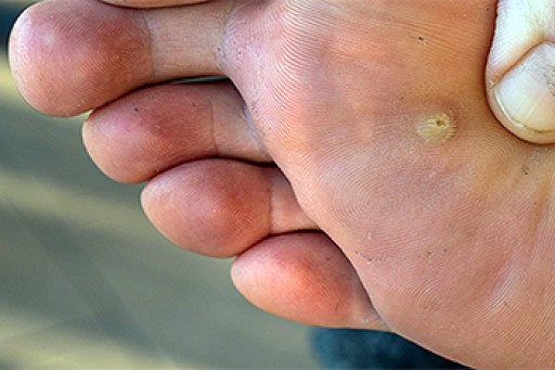 How Plantar Warts Spread