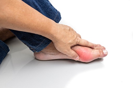 Gout's Impact on Foot Health