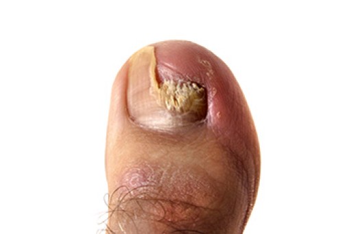 How to Treat Your Toenail Fungus