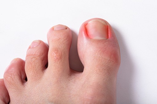 How to Know if You Have an Ingrown Toenail - Blog